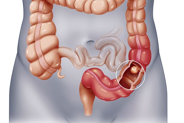 Đau tức bụng dưới bên trái – Triệu chứng của những bệnh nguy hiểm