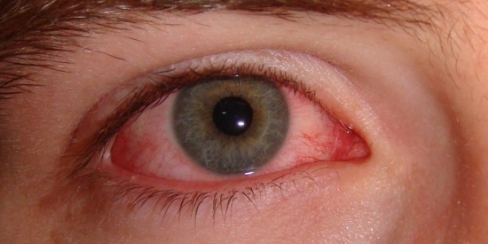 5 lưu ý các mẹ không được quên khi điều trị đau mắt đỏ cho trẻ tại nhà