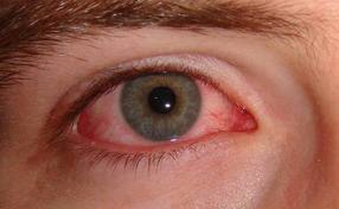 Bệnh đau mắt đỏ kéo dài bao lâu thì khỏi?