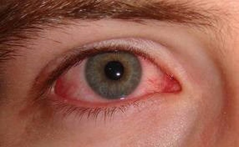 Bệnh đau mắt đỏ lây truyền qua đường nào?