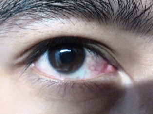 Bệnh mắt đỏ có nặng nếu chỉ ra ít ghèn?