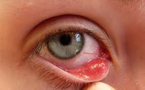Cách chữa bệnh đau mắt đỏ nhanh khỏi nhất