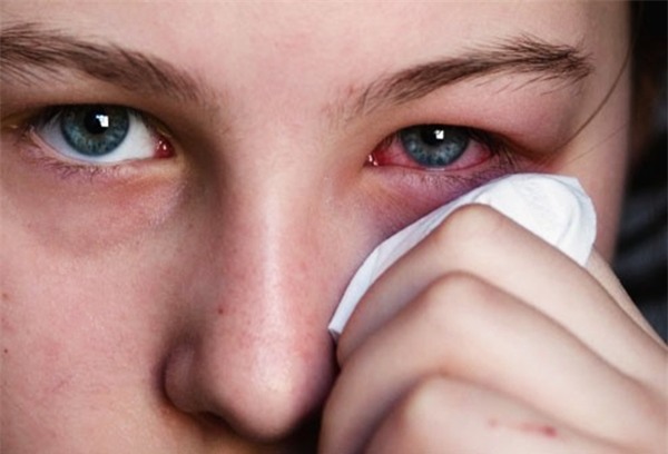 Cách xử lý khi bị đau mắt đỏ