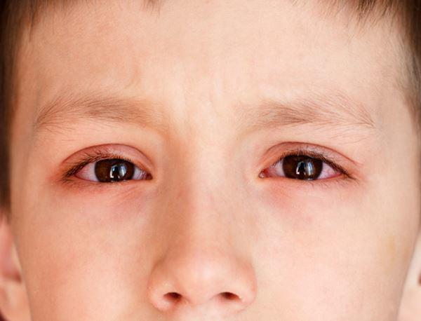 Đau mắt đỏ ở trẻ được chuẩn đoán qua những dấu hiệu triệu chứng nào?