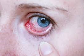 Điêu trị bệnh đau mắt đỏ bằng dầu dừa nguyên chất
