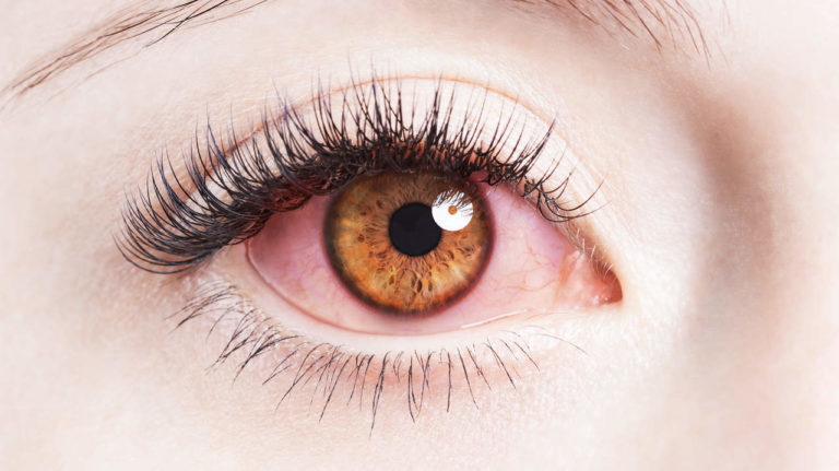 Hiện tượng đau mắt đỏ sẽ kéo dài bao lâu?