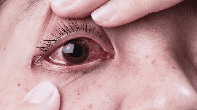 Phân biệt đau mắt đỏ và dị ứng thường gặp vào mùa xuân